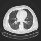 Welder's lung, pulmonary siderosis: CT - Computed tomography